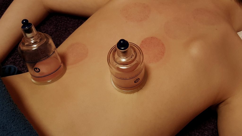 Cupping Treatment: The Essential Guide