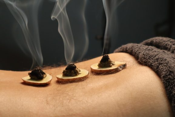 moxibustion therapy in action