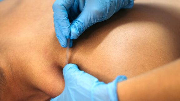 Physiotherapy Needling