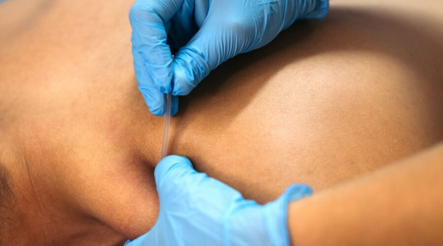 Dry Needling for Pain Management by Physiotherapy